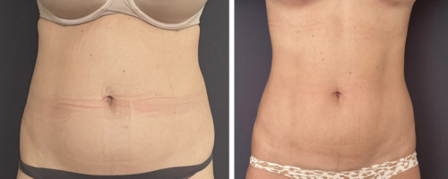 1-Before-After-abdomen-liposuction-3