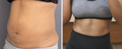 1-Before-After-abdomen-liposuction-4