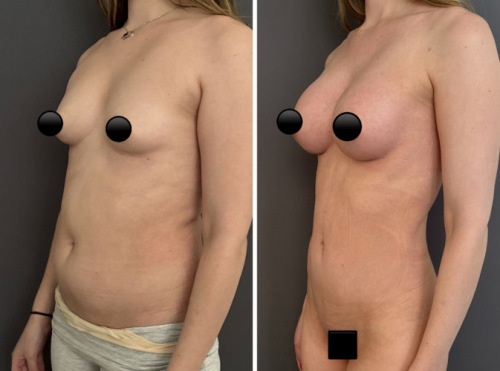 Before-After-Liposuction-NYC-9