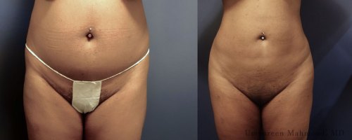 Before-After-abdomen-liposuction