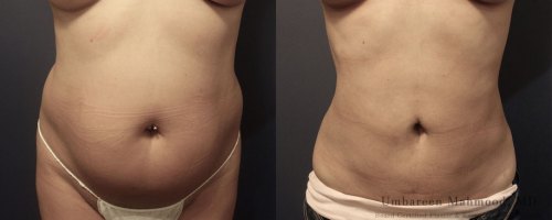 Before-After-female-waist-liposuction-front-2
