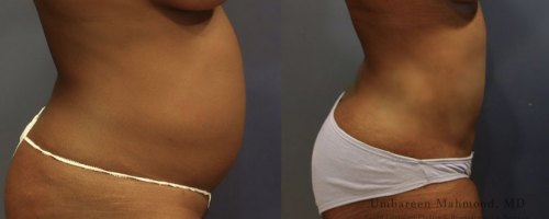Before-After-waist-liposuction-female-profile