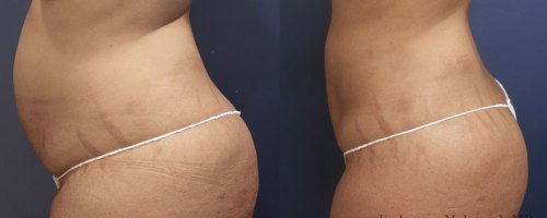 Before-After-waist-liposuction