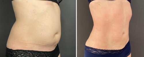 abdomen-liposuction-before-after-1