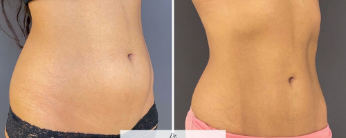 abdomen-liposuction-before-after-2