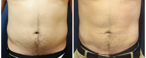 abdomen-liposuction-before-after-3