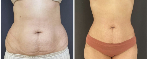 abdomen-liposuction-before-after-4