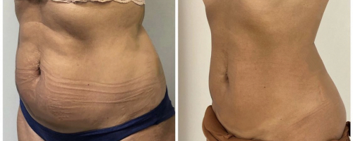 abdomen-liposuction-before-after-5