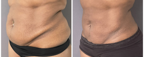 before-after-abdomen-liposuction-nyc-1-1