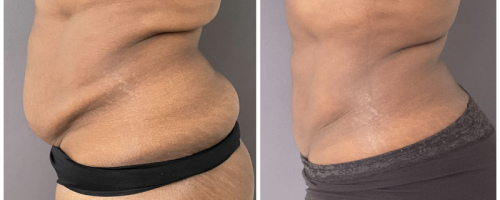 before-after-abdomen-liposuction-nyc-1-2