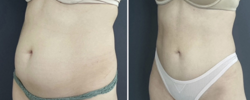 before-after-abdomen-liposuction-nyc-4