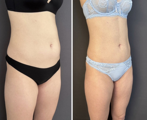 before-after-abdomen-liposuction-nyc-5