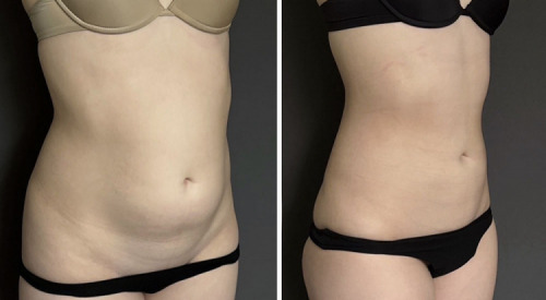 before-after-abdomen-liposuction-nyc-8-1