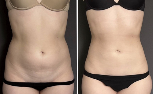 before-after-abdomen-liposuction-nyc-8-2