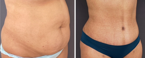 before-after-female-abdominoplasty-liposuction-20