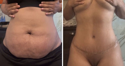 6_before-after-photo-abdominoplasty-plastic-surgery-nyc-36