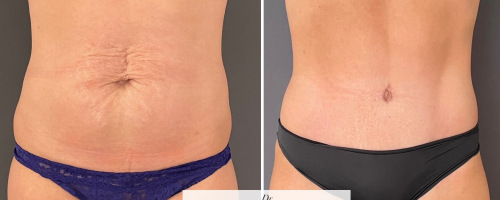 Abdominoplasty-and-liposuction-before-and-after-photo-032723-2