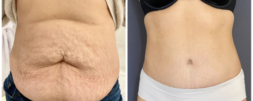 Abdominoplasty-and-liposuction-of-waist-before-and-after-photo-032723-1
