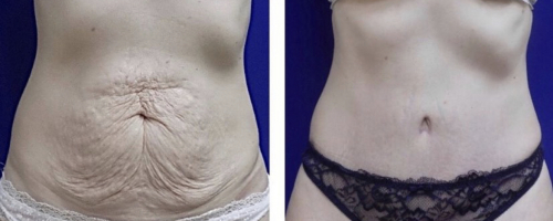 abdominalplasty-before-after-1