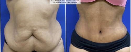 abdominalplasty-before-after-2