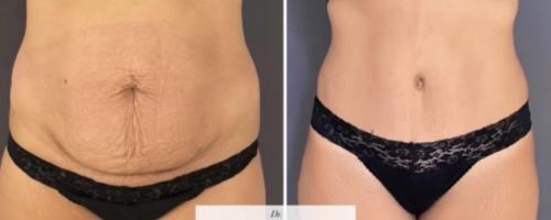 abdominoplasty-before-and-after-photo-032723-3