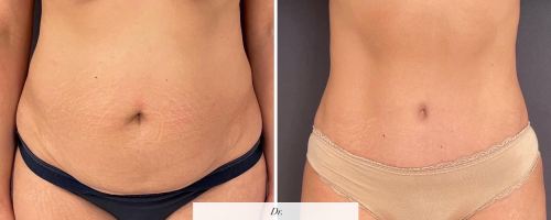 abdominoplasty-before-and-after-photo-032723-4