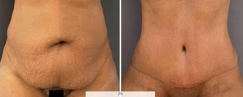 abdominoplasty-before-and-after-photo-032723-7