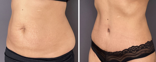 abdominoplasty-liposuction-before-after