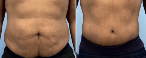 before-after-abdominoplasty-14
