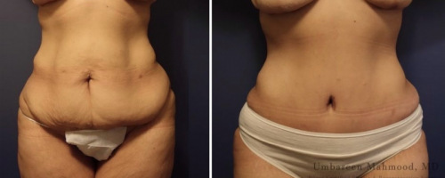 before-after-abdominoplasty-15