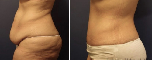 before-after-abdominoplasty-16