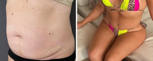 before-after-abdominoplasty-17