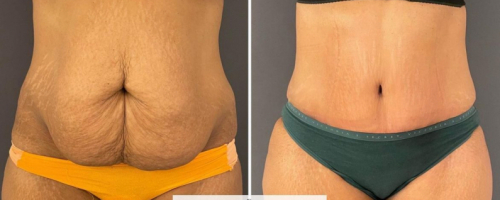 before-after-abdominoplasty-18