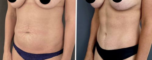 before-after-abdominoplasty-nyc-26