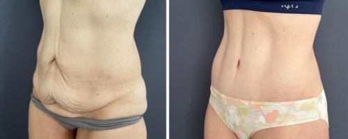 before-after-female-abdominoplasty-10