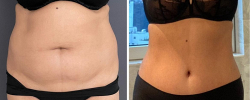 before-after-female-abdominoplasty-11