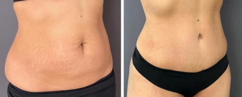 before-after-female-abdominoplasty-12