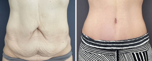 before-after-female-abdominoplasty-13