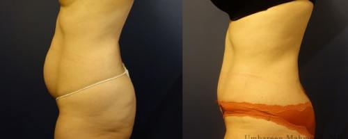 before-after-female-abdominoplasty-2