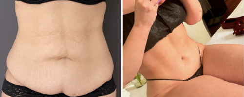 before-after-female-abdominoplasty-22