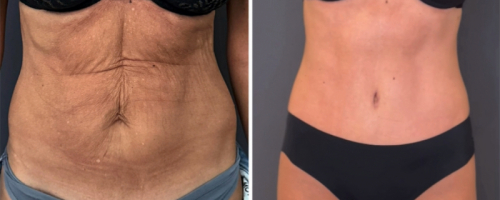 before-after-female-abdominoplasty-23