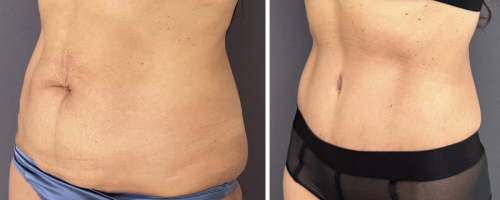 before-after-female-abdominoplasty-24