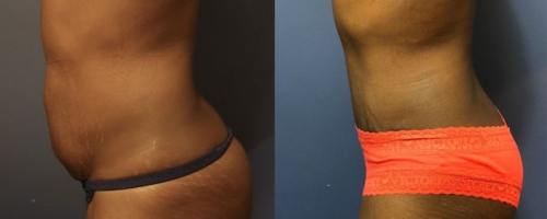 before-after-female-abdominoplasty-3