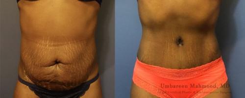 before-after-female-abdominoplasty-4