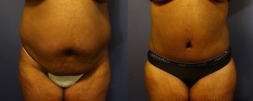 before-after-female-abdominoplasty-5