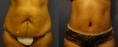 before-after-female-abdominoplasty-7