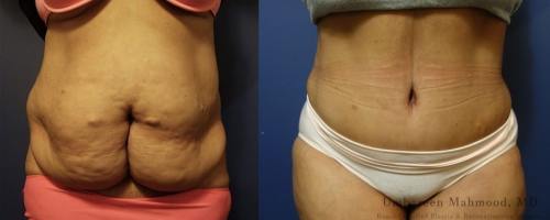 before-after-female-abdominoplasty-8