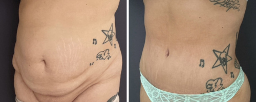 before-after-female-abdominoplasty-liposuction-21