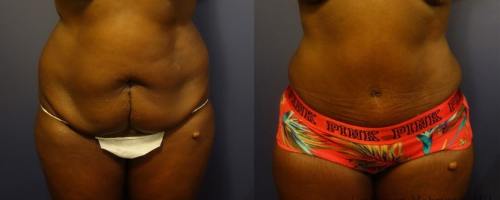 before-after-female-abdominoplasty