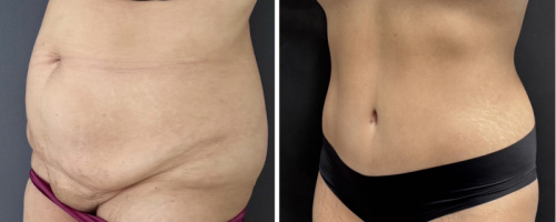 before-after-photo-abdominoplasty-nyc-27